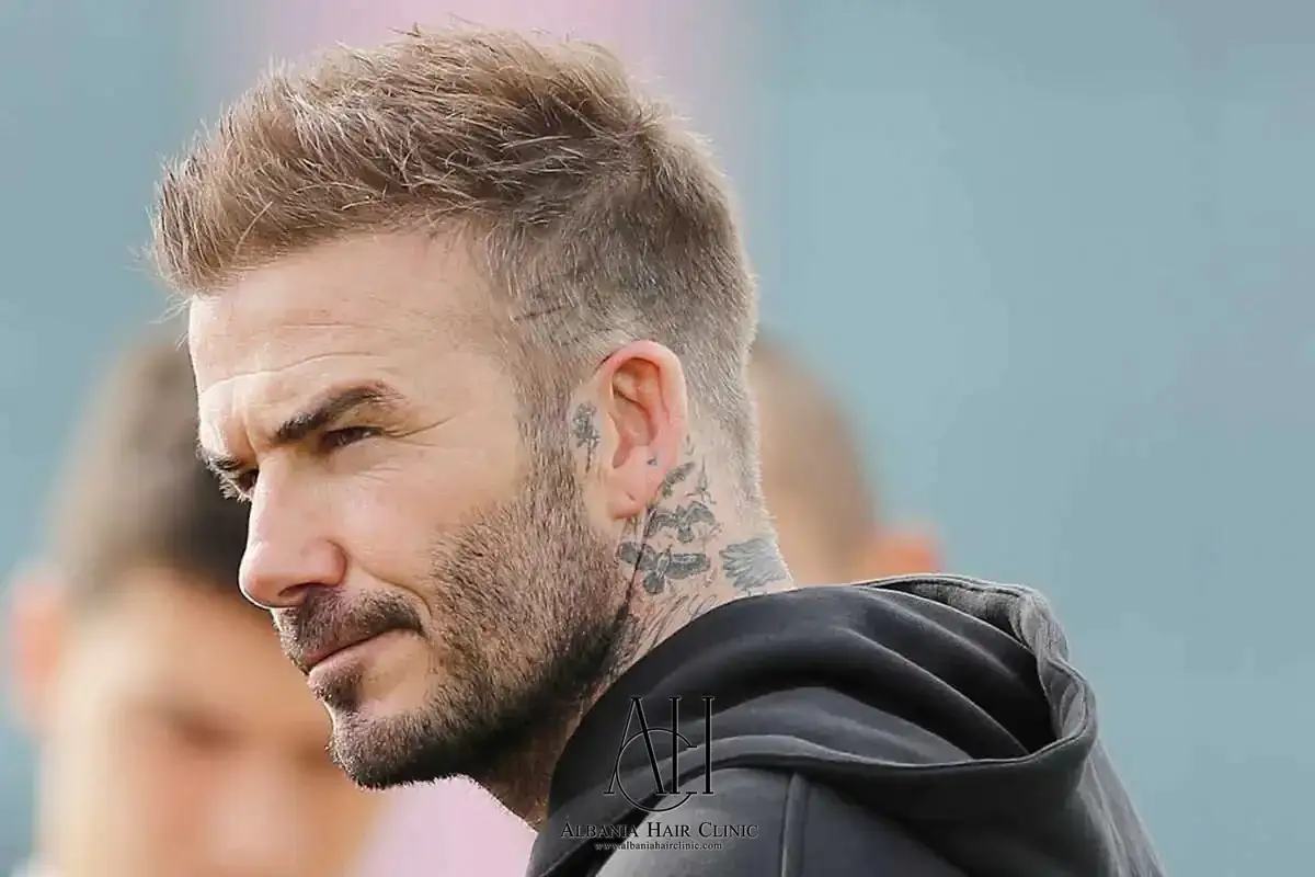 Transplanti i flokëve i David Beckham