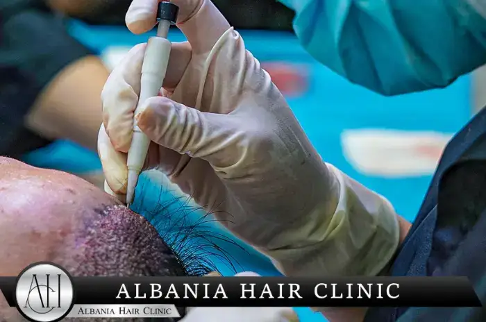Joel McHale dhe katër transplantet e flokëve: çfarë ka thënë vetë