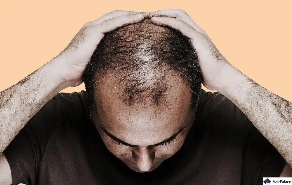 Transplanti i flokëve i Theo Baker: çfarë publikoi vetë ai