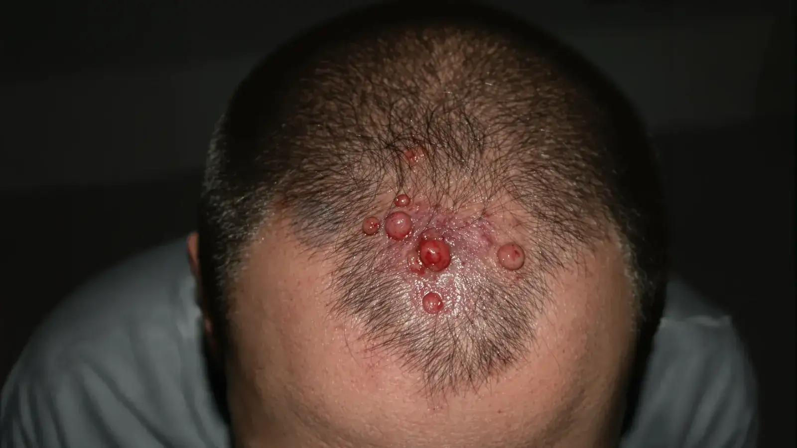 Close-up of infected hair follicles on a scalp with red bumps and pus