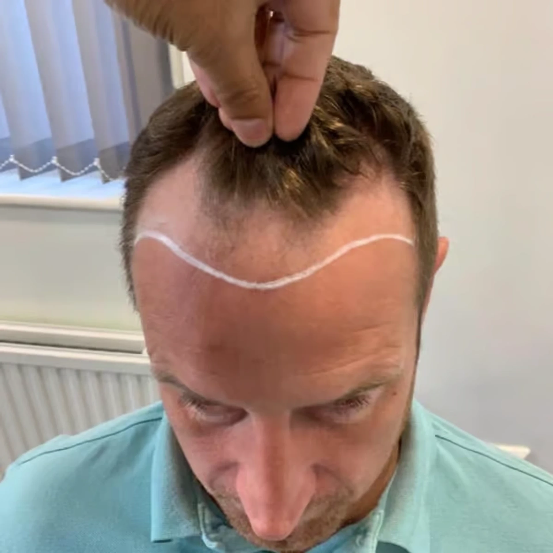 dopo il trapianto di capelli
