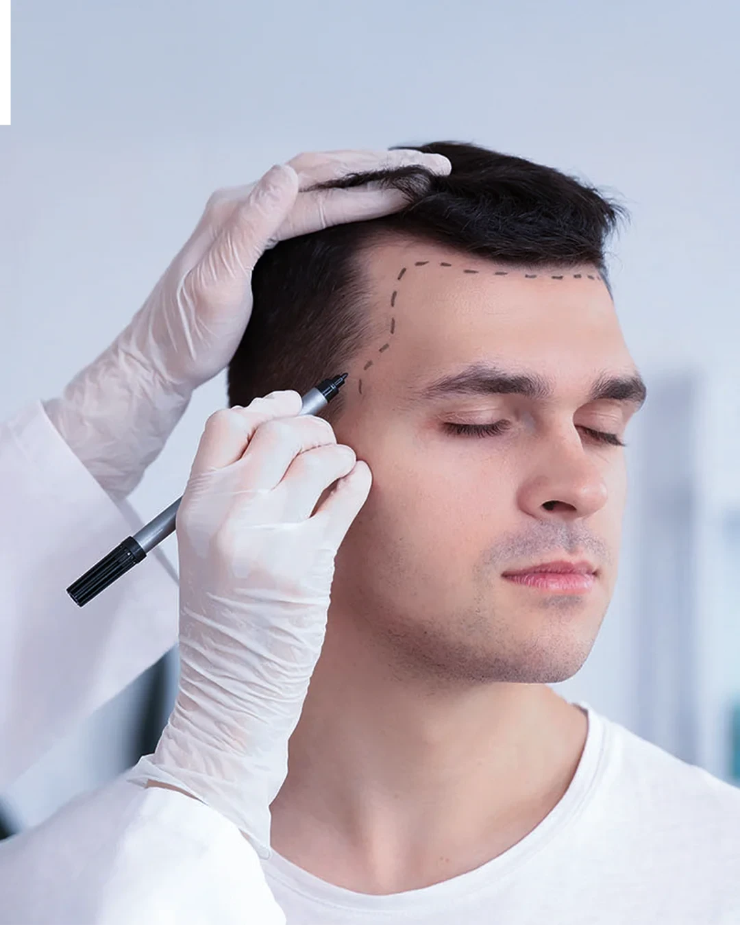 what-is-dhi-trapianto-di-capelli