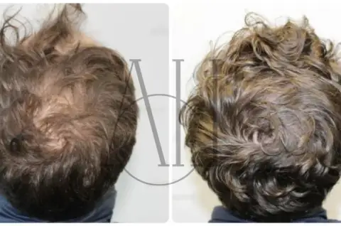 minoxidil for men
