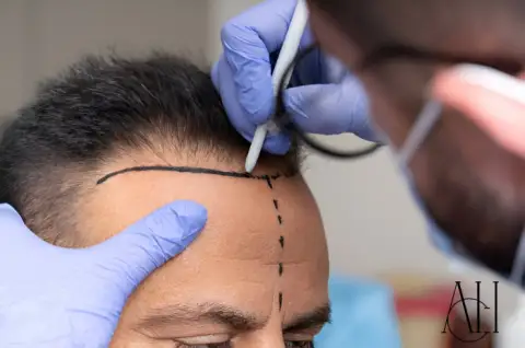 Cost Comparison: DHI vs FUE