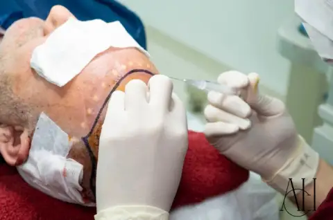 follicular unit extraction fue in albania