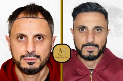 after hair transplantation