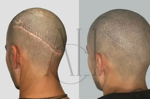 before scalp micropigmentation