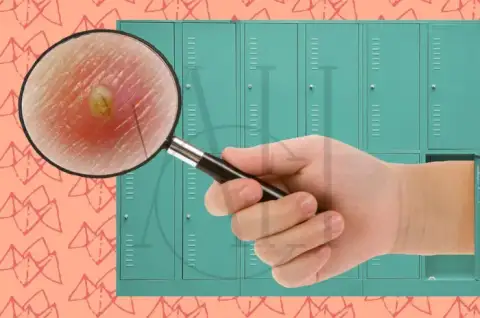 Herpes symptoms