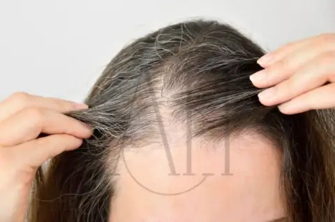 telogen effluvium diagnosis