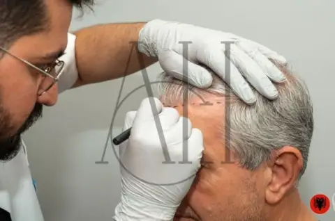 All-Inclusive Hair Transplant Packages in Albania