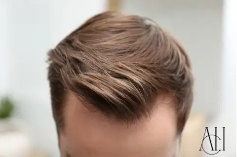 hair transplant recovery timeline