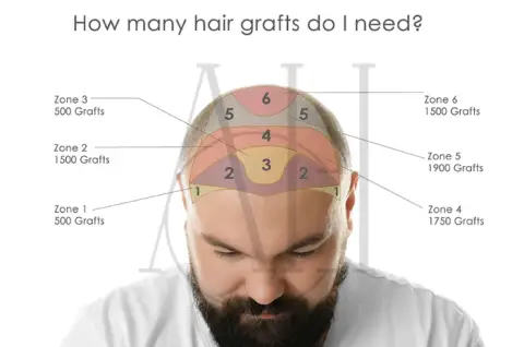 Norwood 3 hair loss