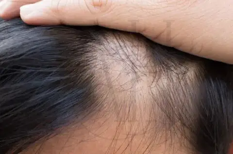 Simptomat dhe Zgjidhjet e Alopecisë Cikatriciale