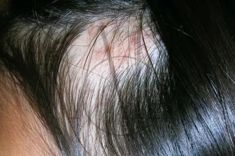 hair pulling disorder