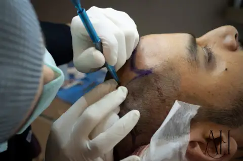 hairstyle after hair transplant