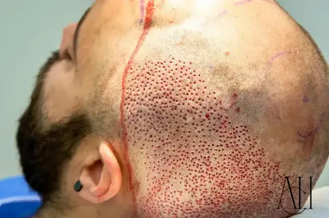 body hair to head transplant