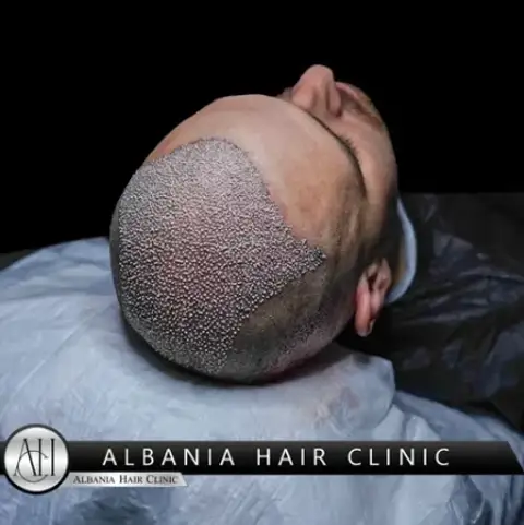 FUE Hair Transplant