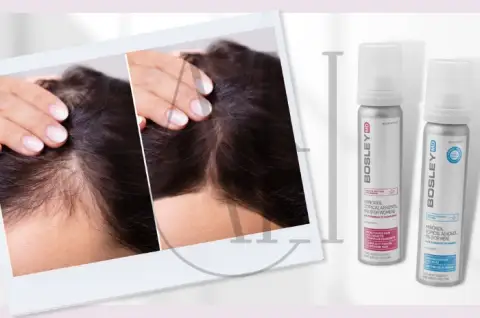 Minoxidil për rritjen e flokëve