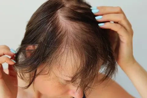 Caduta capelli donna.jpg