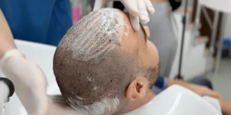 albania hair clinic