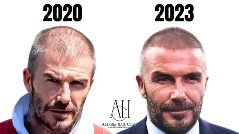 hair translpant of david beckham