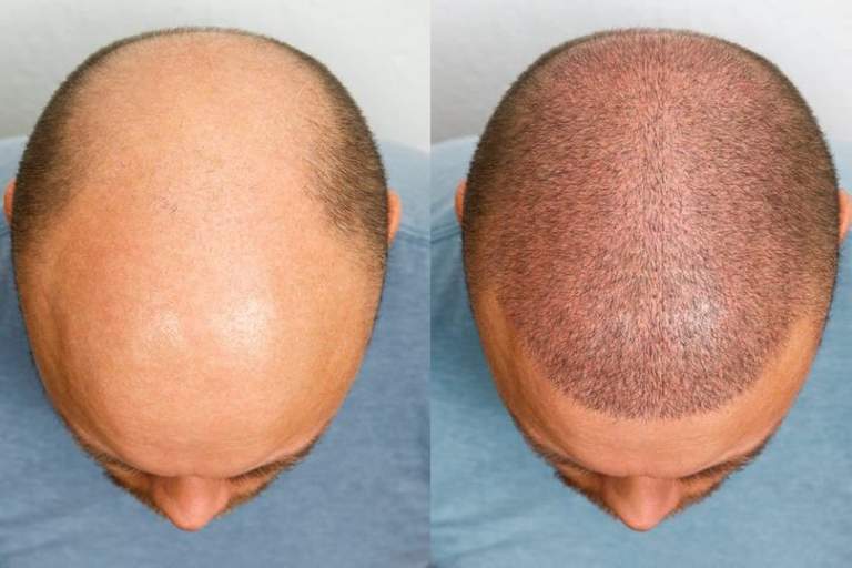 Trapianto Capelli a Tirana.jpeg