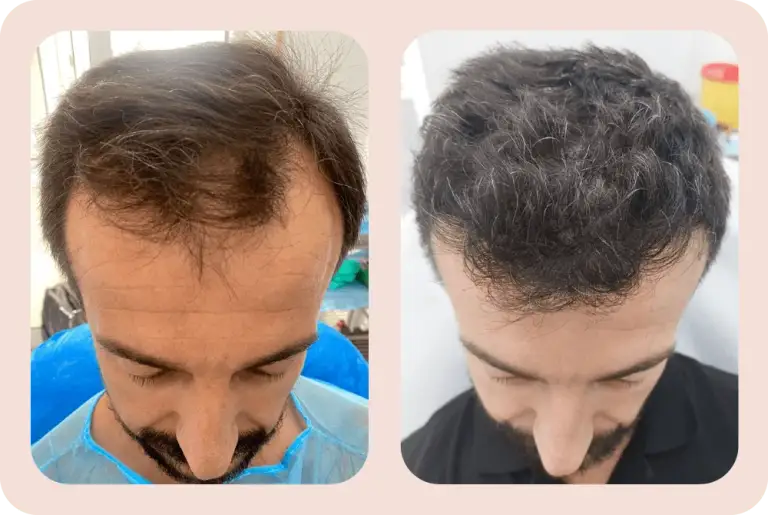 Trapianto Capelli a Tirana- Costi e Tecniche .png