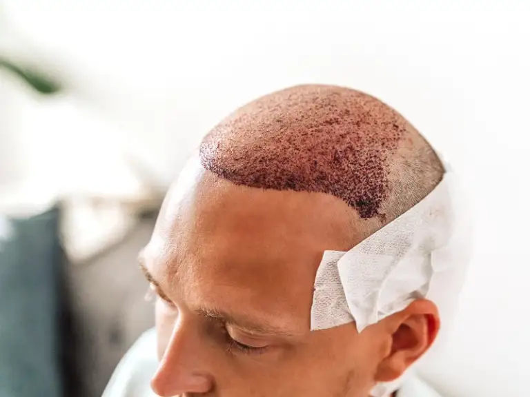 What to Do After a Hair Transplant? .png