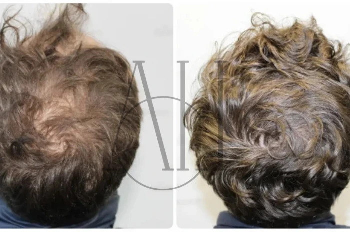 minoxidil for men