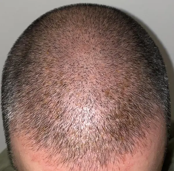 after hair transplantation
