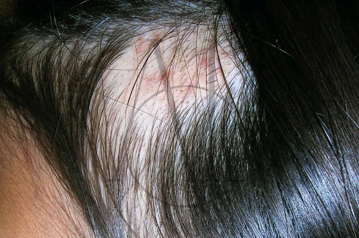 hair pulling disorder