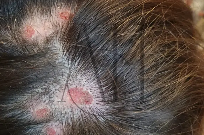 Scalp Biopsy
