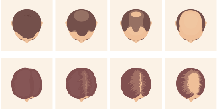 Norwood Scale- Degrees of Baldness .webp