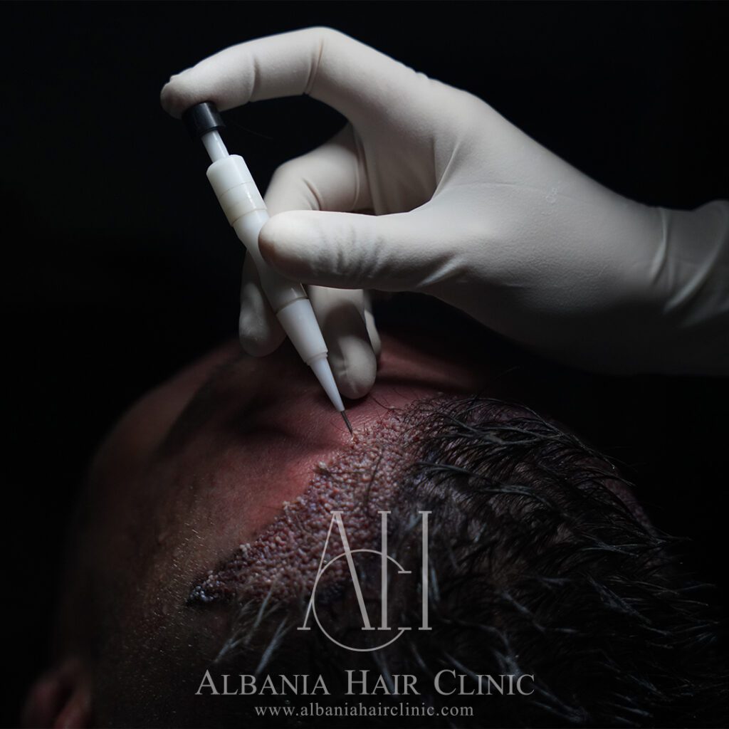 Abous us - Best Hair Transplant Clinic