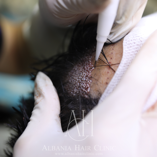 Hair transplant technology advancements