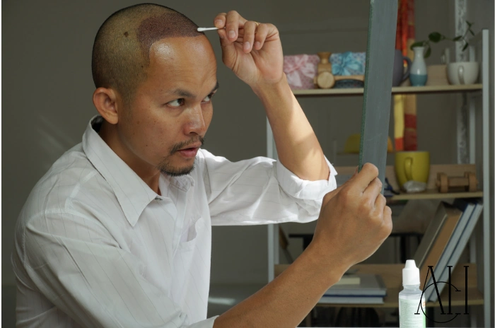 after hair transplantation