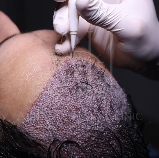 Discover how different seasons impact hair transplant recovery and results. Plan your hair restoration for optimal outcomes.