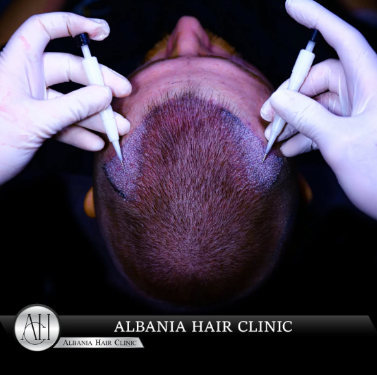 Learn about redness and irritation after hair transplant, why they occur, and how to manage and speed up recovery effectively.