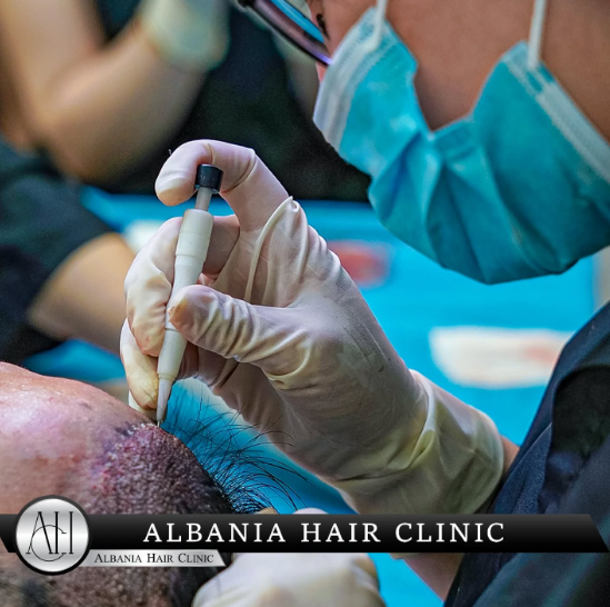 Discover how hair transplants can combat hair loss and dandruff, ensuring a healthier scalp and restored confidence.