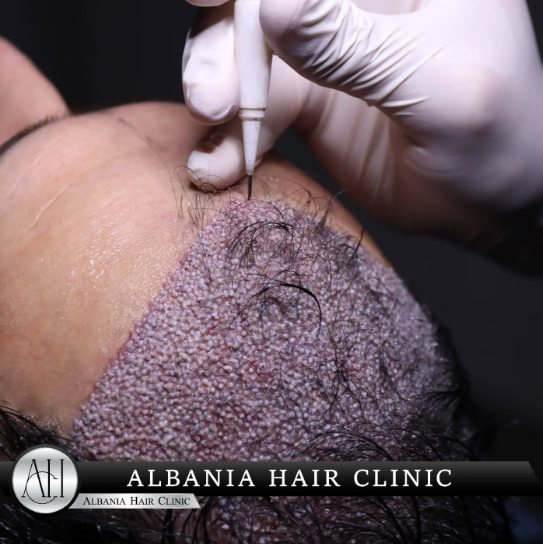 FUE Hair Transplant in Turkey