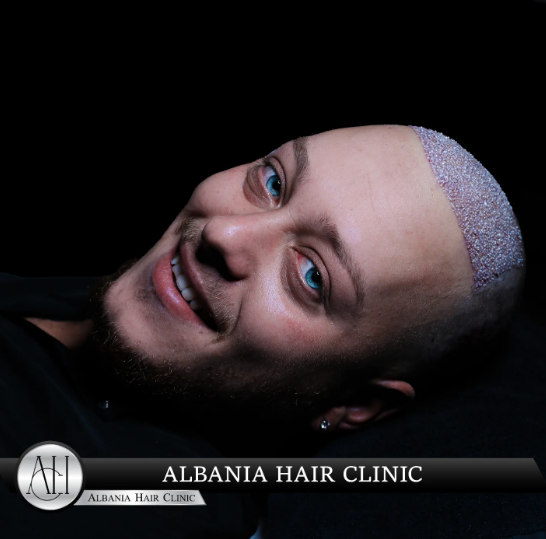 Discover why Turkey is the top destination for 5000 grafts hair transplants. Learn about costs, procedures, and top clinics!