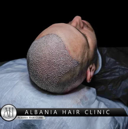 FUE Hair Transplant in Turkey