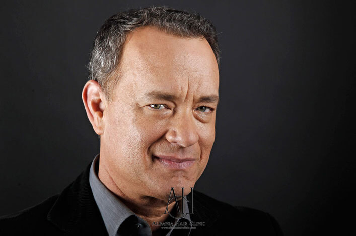 Tom Hanks Hair Transplant