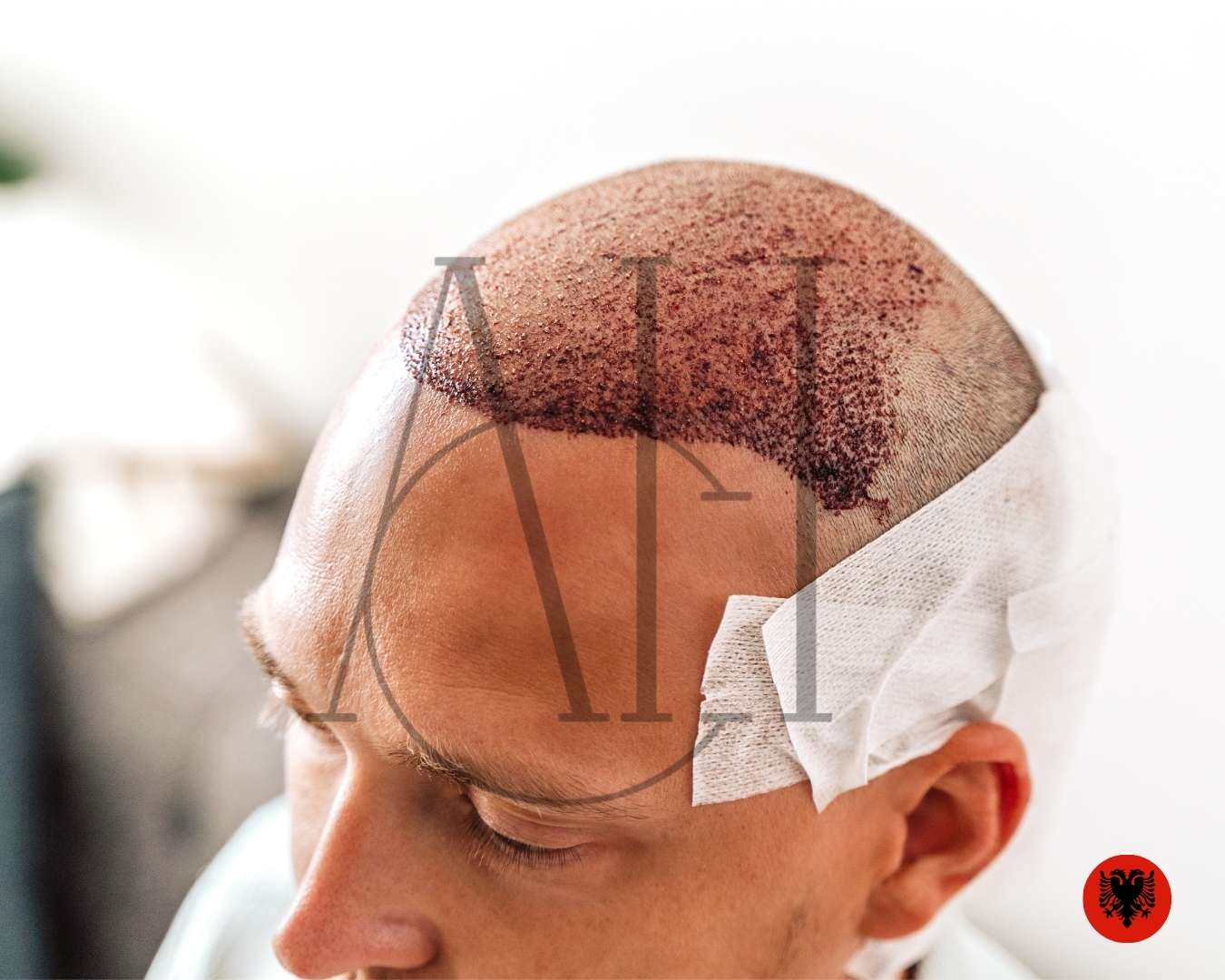 Albania Hair Clinic