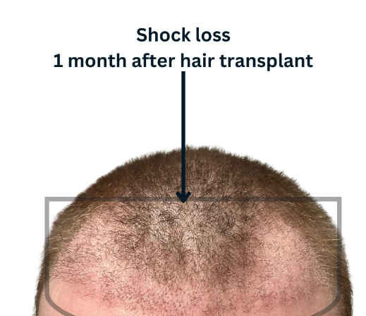 Hair Transplant in Tirana - Albania