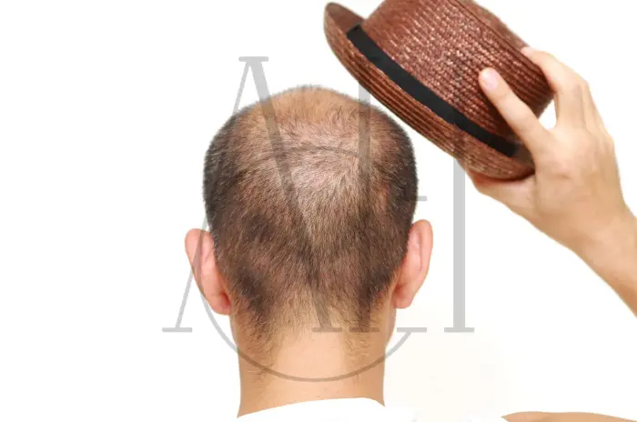 Does Wearing a Hat Cause Hair Loss