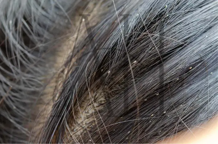 What Do Head Lice Look Like Symptoms & Removal Tips