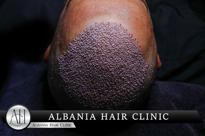 do hair transplants last​