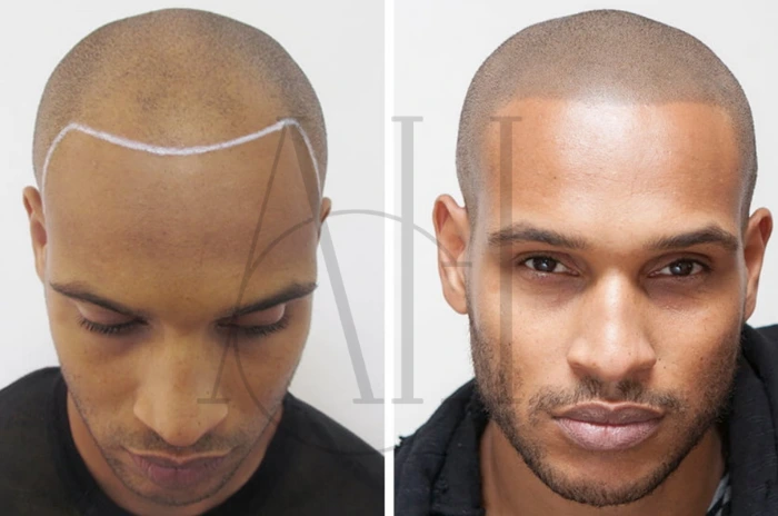 head tattoo hair