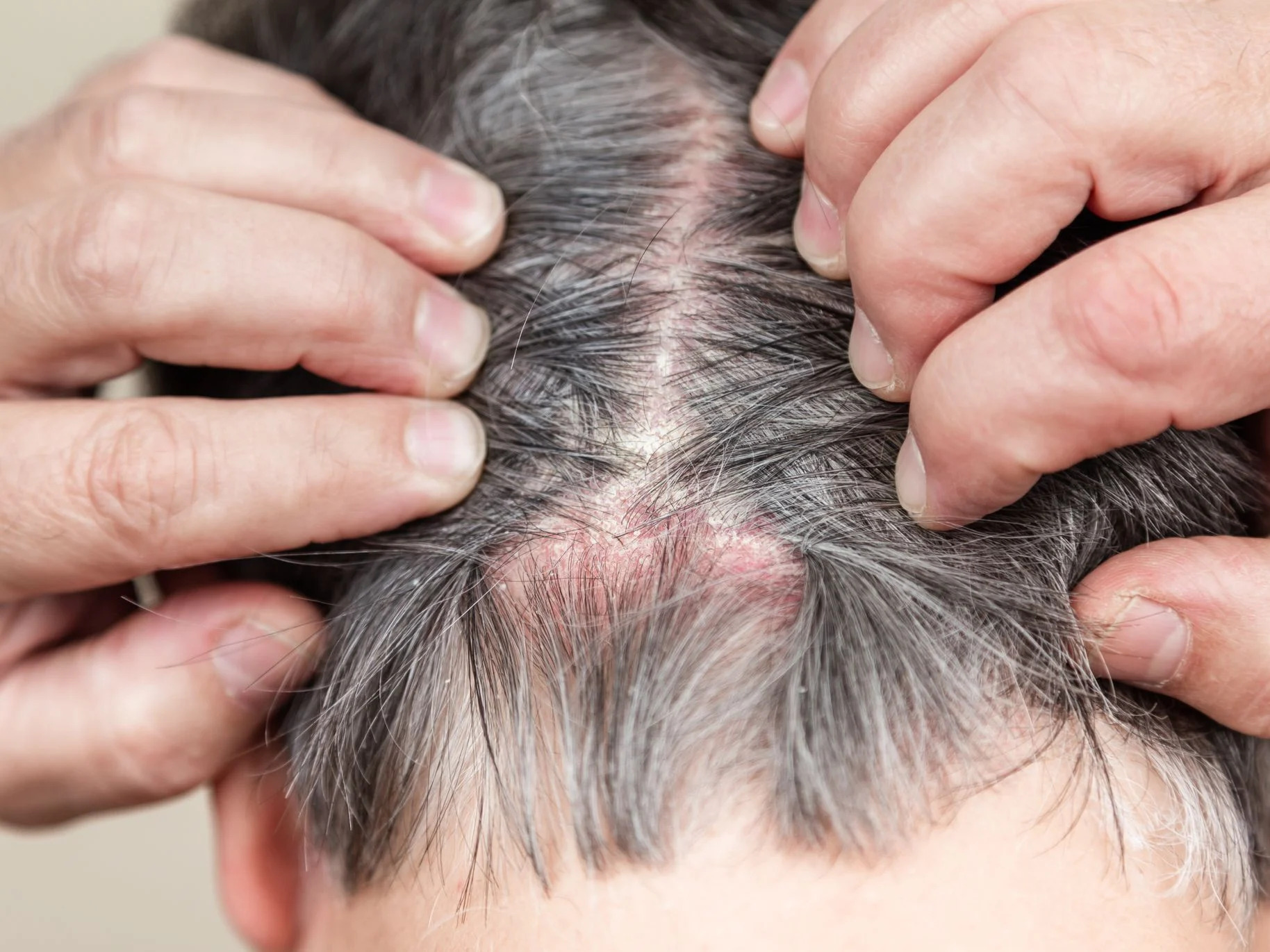 itchy-scalp-and-hair-loss